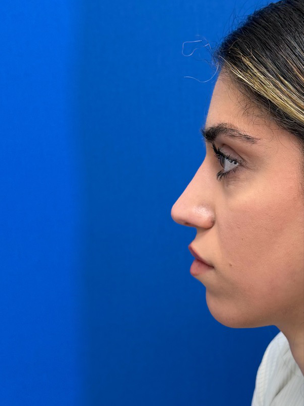 Rhinoplasty Before & After Image