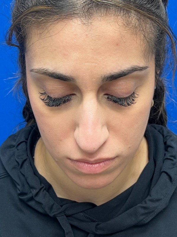 Rhinoplasty Before & After Image