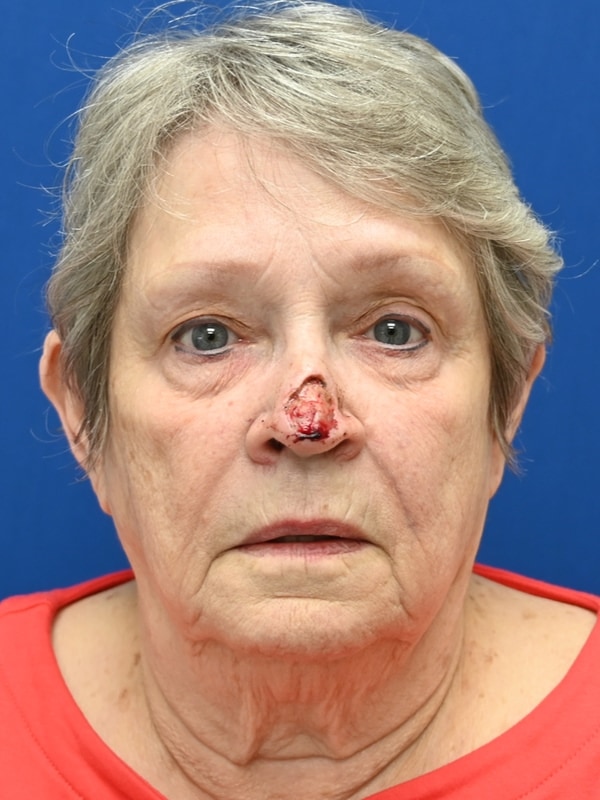Skin Cancer Reconstruction Before & After Image