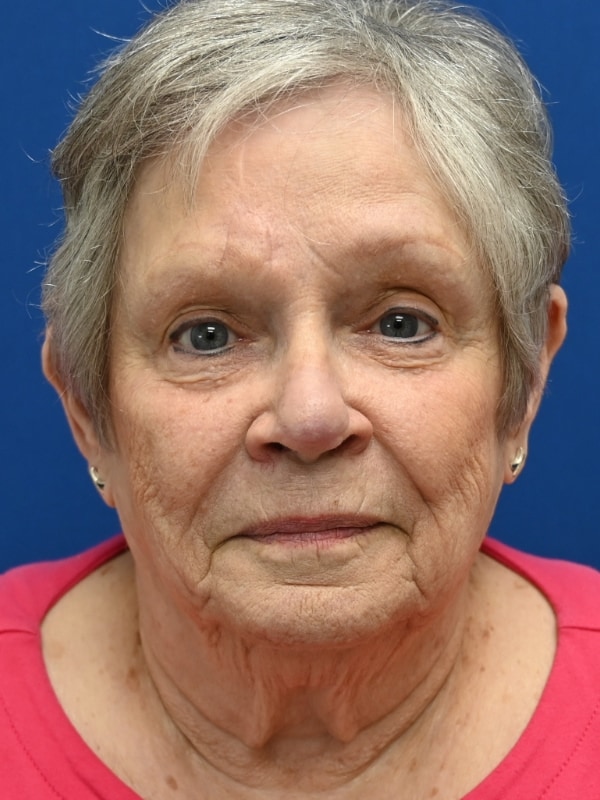Skin Cancer Reconstruction Before & After Image
