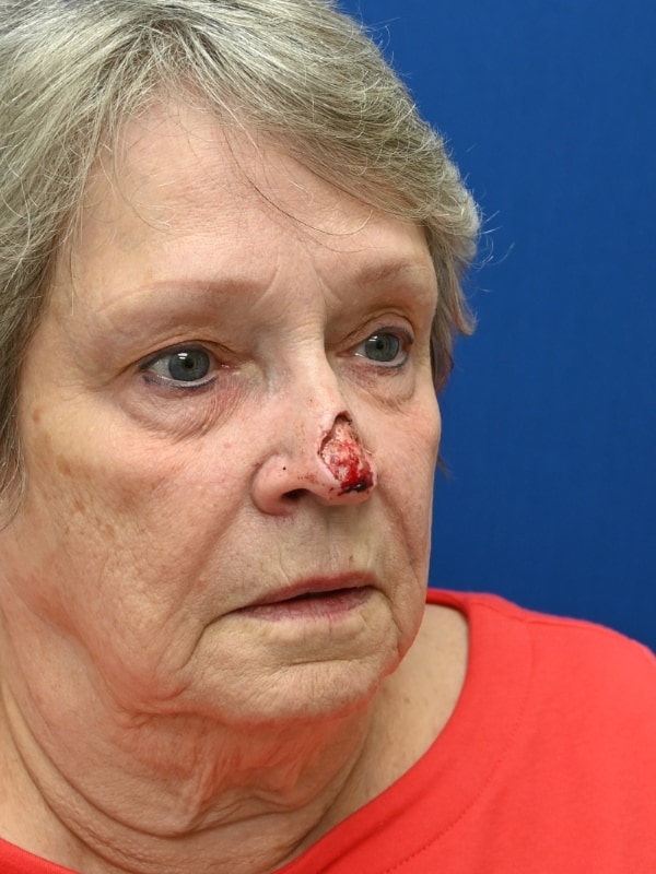 Skin Cancer Reconstruction Before & After Image