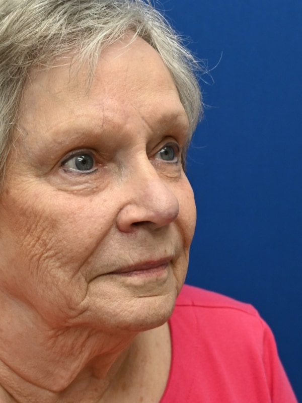 Skin Cancer Reconstruction Before & After Image