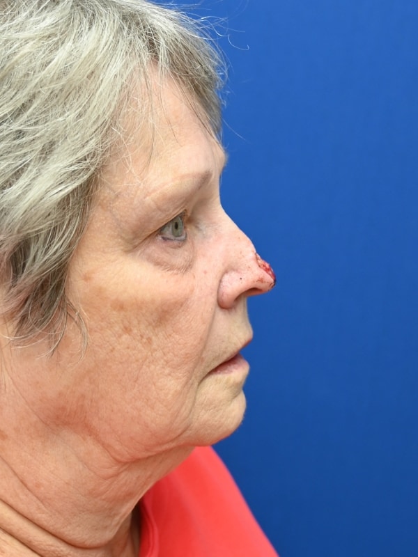 Skin Cancer Reconstruction Before & After Image