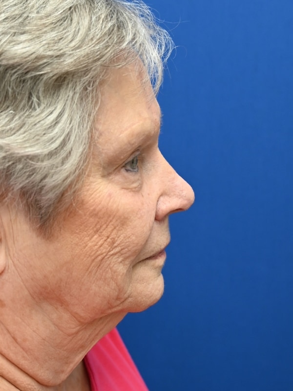 Skin Cancer Reconstruction Before & After Image