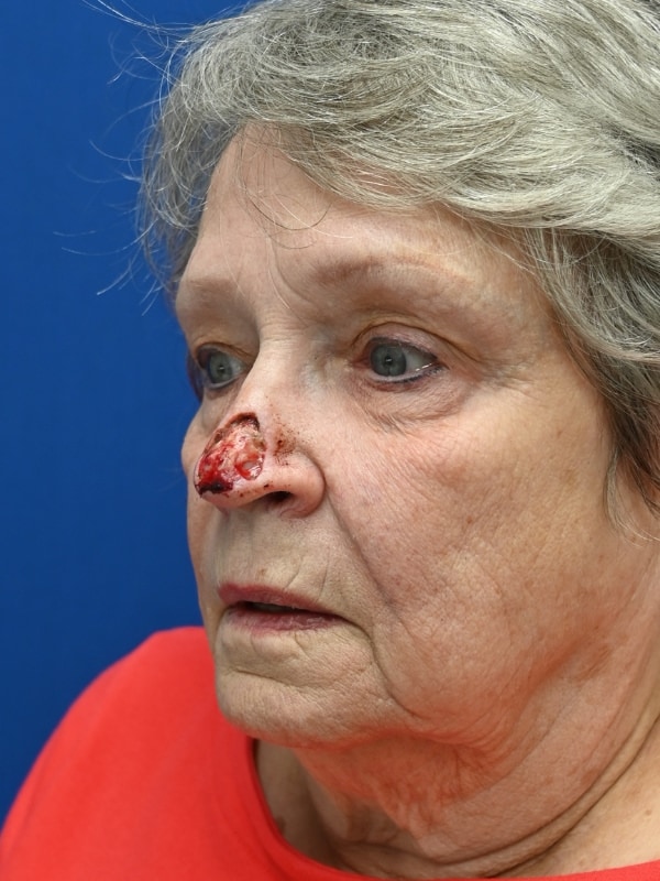 Skin Cancer Reconstruction Before & After Image