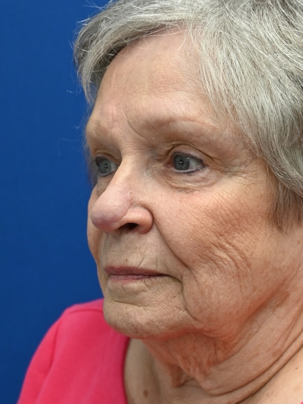 Skin Cancer Reconstruction Before & After Image