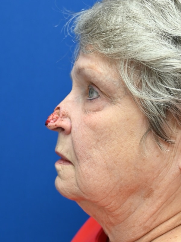 Skin Cancer Reconstruction Before & After Image