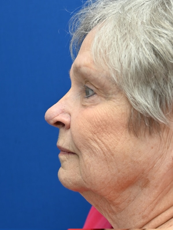 Skin Cancer Reconstruction Before & After Image