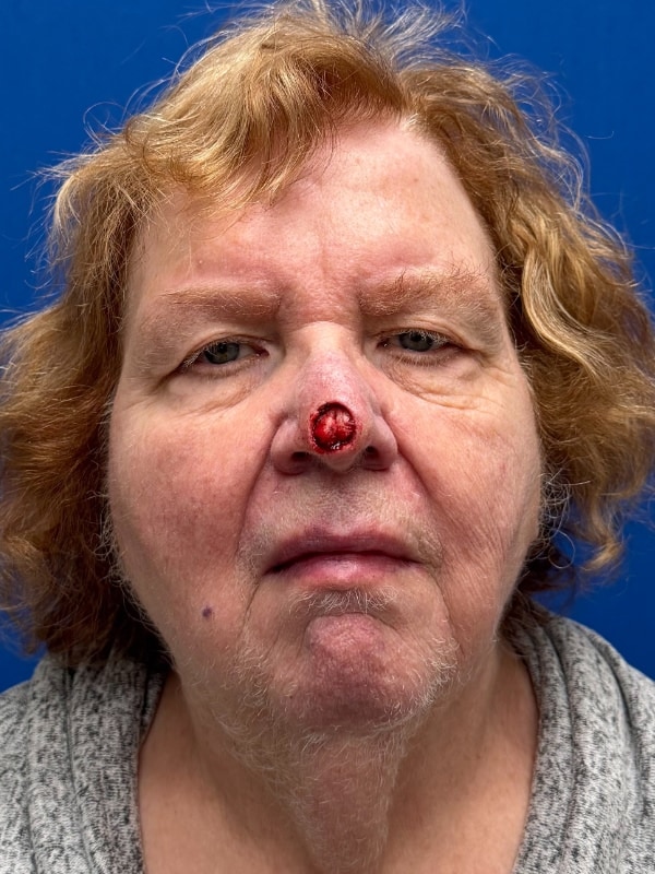 Skin Cancer Reconstruction Before & After Image
