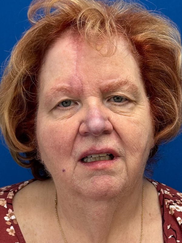 Skin Cancer Reconstruction Before & After Image
