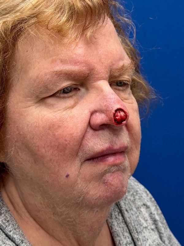 Skin Cancer Reconstruction Before & After Image