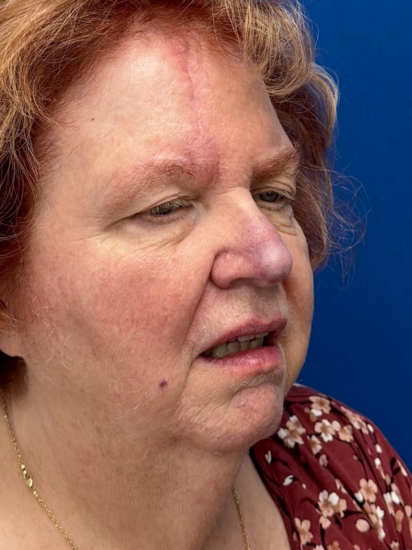Skin Cancer Reconstruction Before & After Image