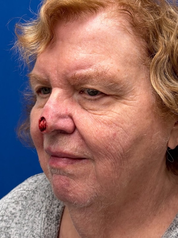 Skin Cancer Reconstruction Before & After Image