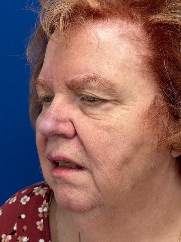 Skin Cancer Reconstruction Before & After Image