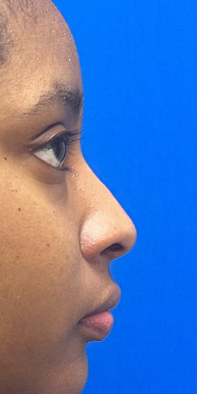 Liquid Rhinoplasty Before & After Image