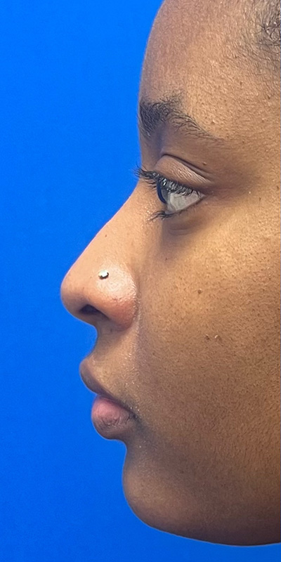 Liquid Rhinoplasty Before & After Image