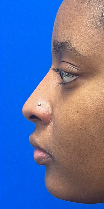 Liquid Rhinoplasty Before & After Image